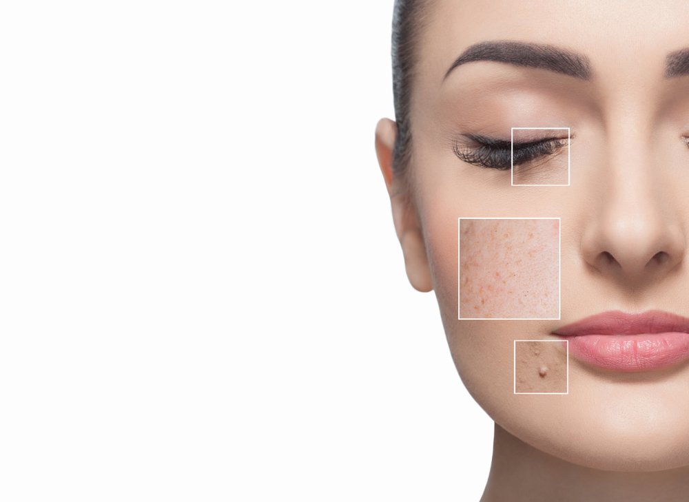 Acne-Pimples Skin Care Exfoliators